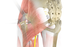 Complex Hip Replacement