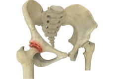 Comprehensive Care of Hip Osteoarthritis