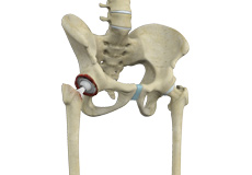 Correction of a Failed Hip Replacement