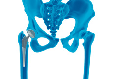 Correction of a Loose Hip Replacement