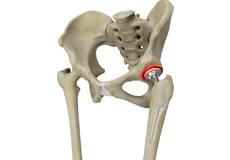 Correction of a Painful Hip Replacement