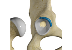 Hip Trauma Reconstruction