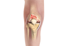 Knee Osteoarthritis