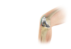 Minimally Invasive Knee Joint Replacement