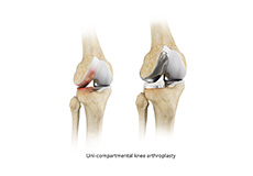 Non-Surgical Knee Treatments