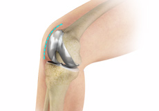 Outpatient Total Knee Replacement