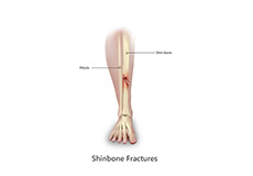 Pediatric Fractures