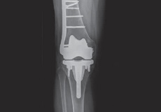 Periprosthetic Knee Fracture Fixation