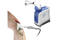 Robotic Assisted Knee Replacement