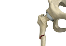 Subtrochanteric Hip Fracture