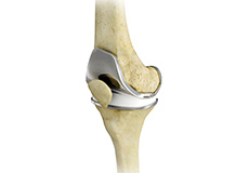 Painful or Failed Total Knee Replacement