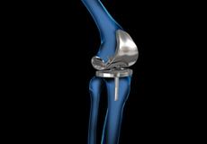 What is New in Knee Replacement